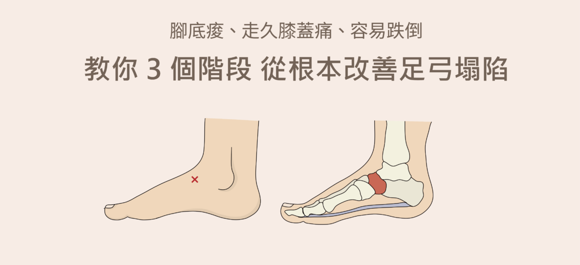 足弓塌陷訓練
